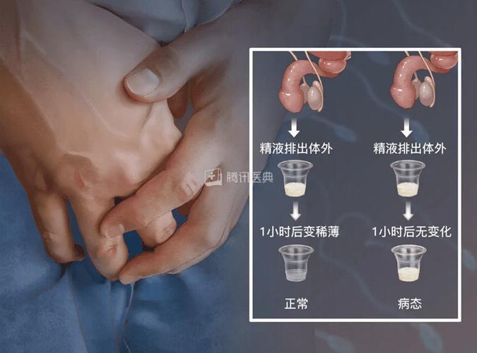 睾丸提取精子