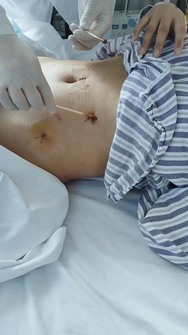 腹水手术