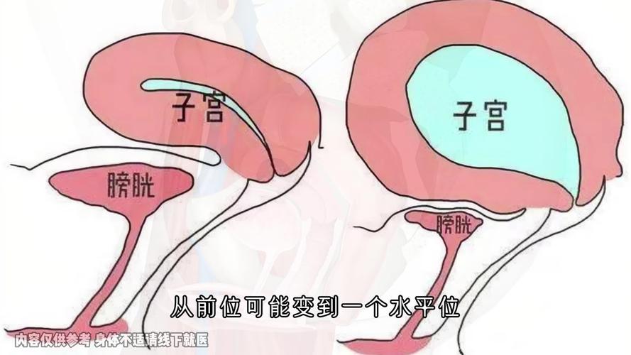 如何在试管移植期间快速憋尿，提升成功率？