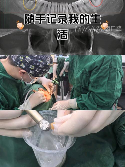 移植前拔牙