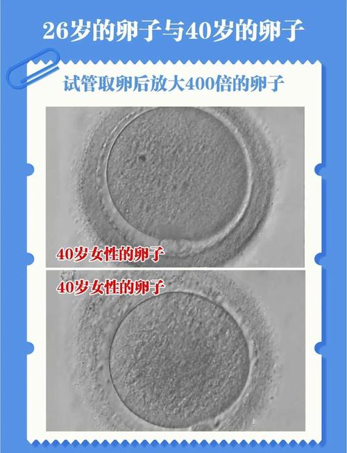  卵子畸形