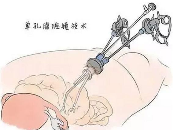 输卵管扎针技术