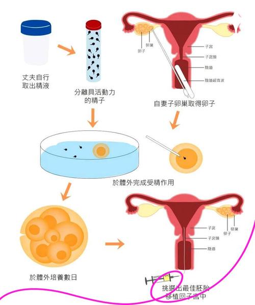 第五代试管婴儿