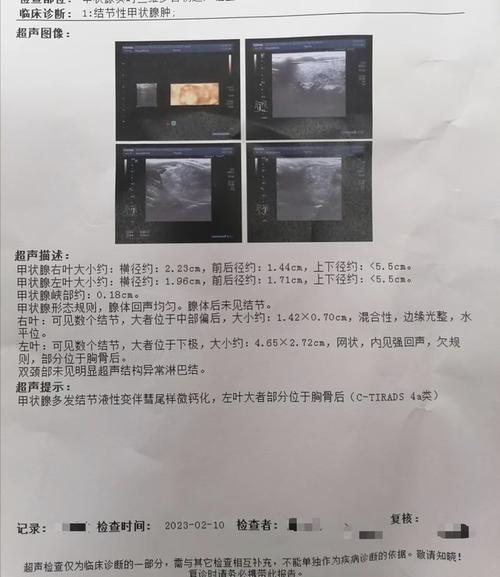 甲状腺B超