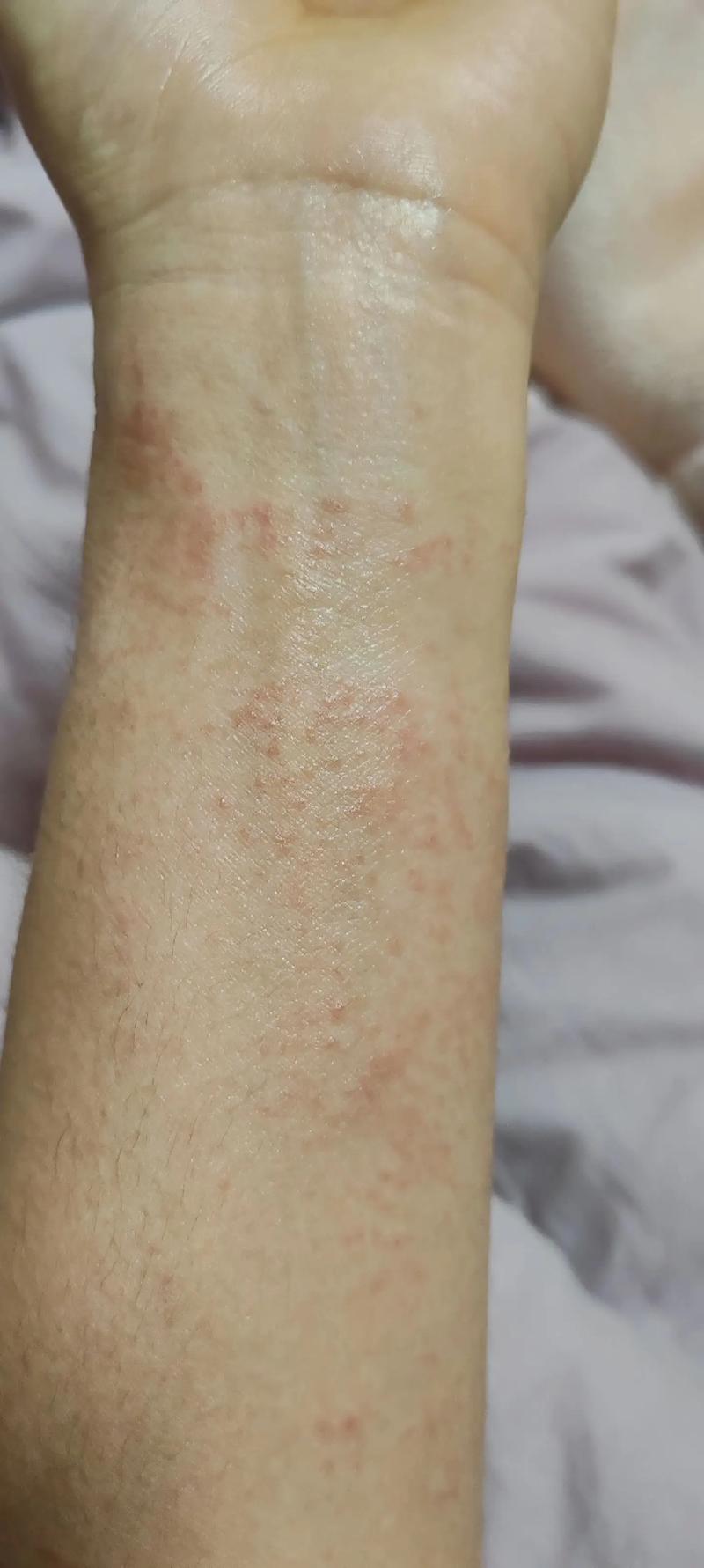 皮肤过敏