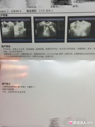 卵泡壁厚