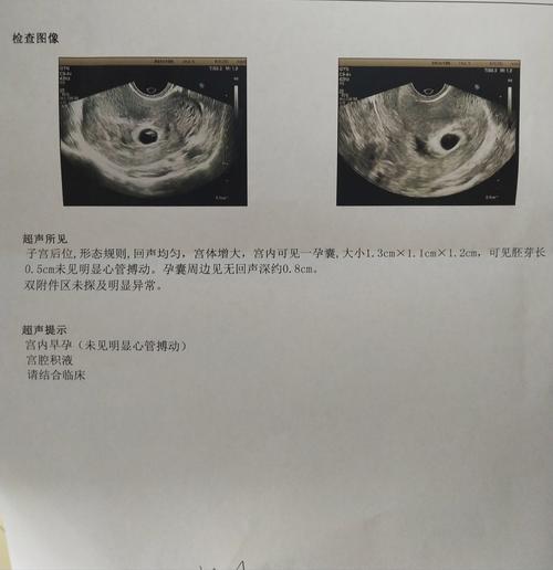 45天无胎心