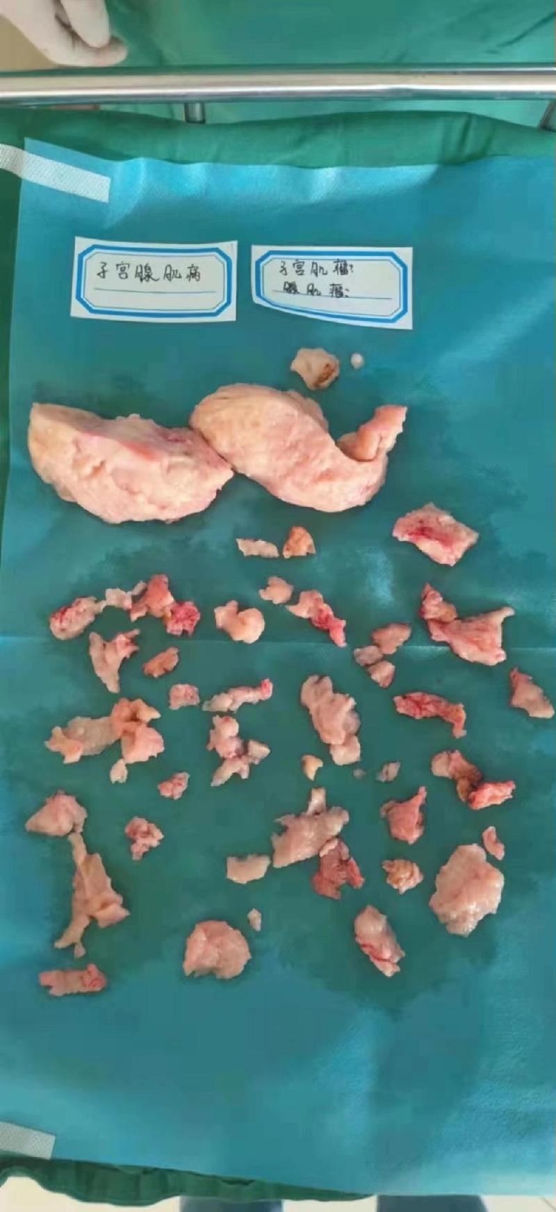 腺肌症移植