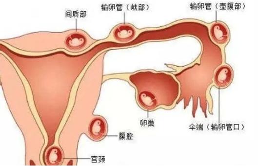  卵巢宫外孕