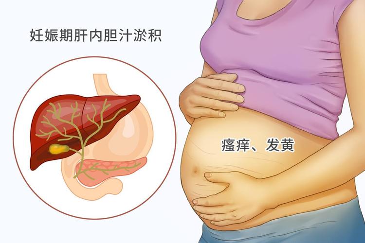 妊娠期肝内胆汁淤积症
