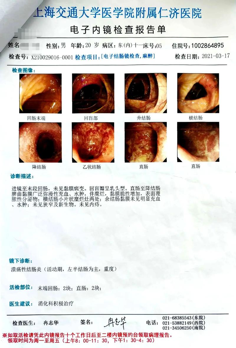 肠炎
