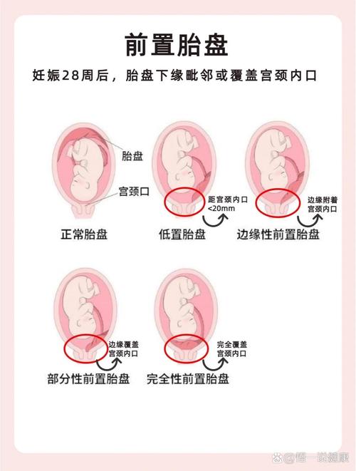  胎盘前置