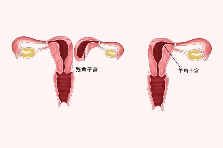 残角子宫
