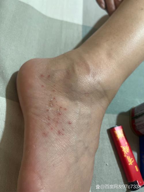 移植后脚痒