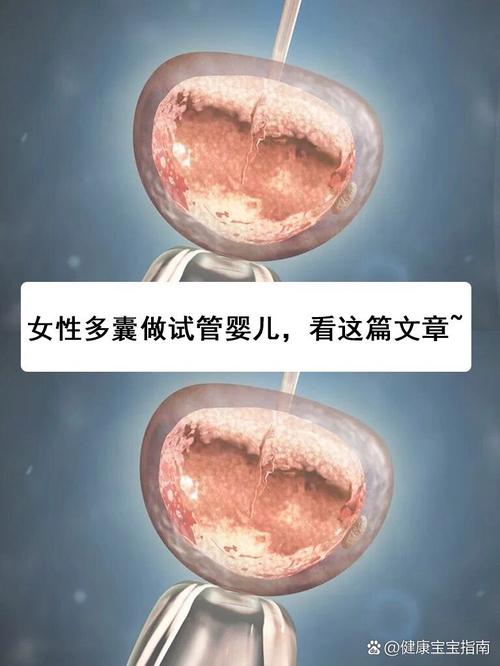 多囊试管婴儿