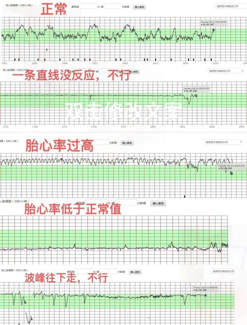 胎心不稳