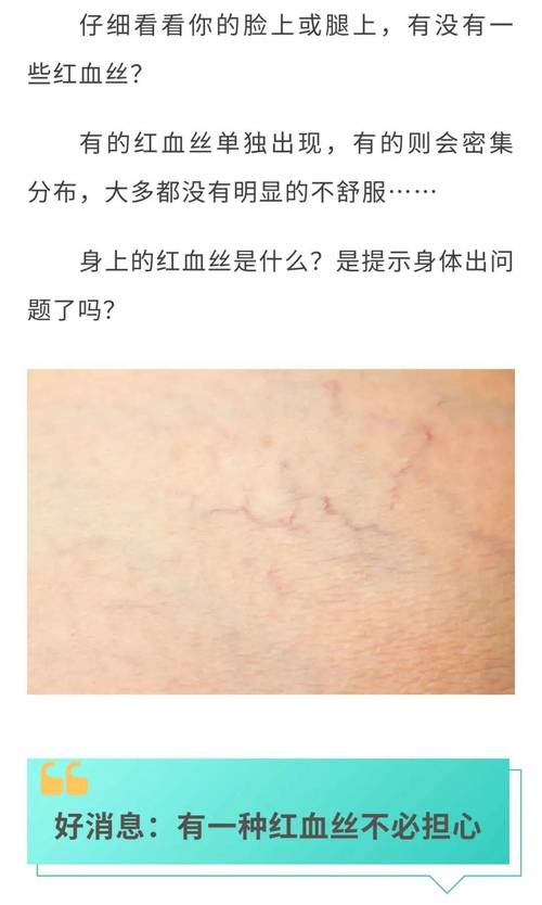 血丝