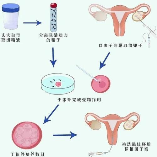 个体化试管婴儿移植技术