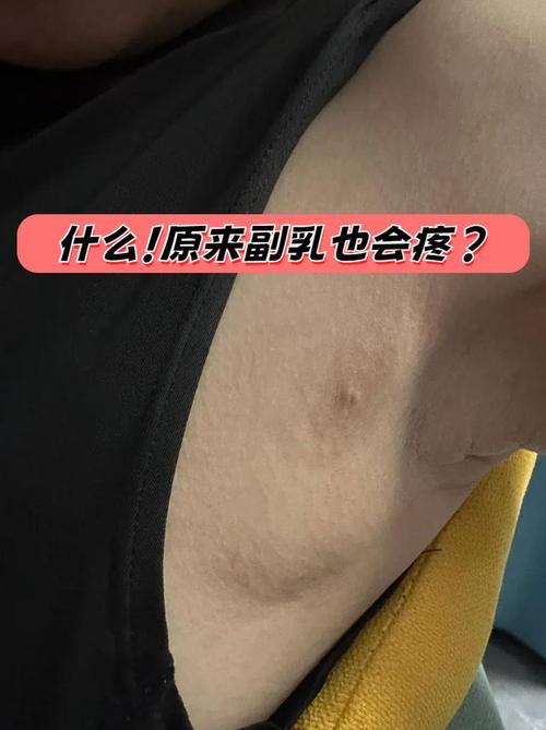 副乳