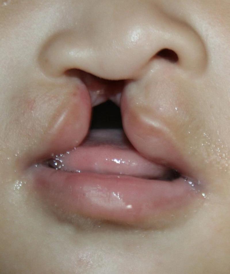  兔唇