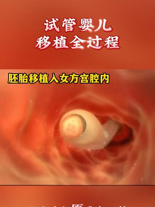 胚胎移植
描述: 本文详细介绍了武汉三代试管婴儿的全过程，从前期准备、促排卵、取卵取精到胚胎培养、筛查、移植及验孕等步骤，结合实际案例和统计数据，为读者全面解读这一技术，助力有需求家庭了解相关知识。