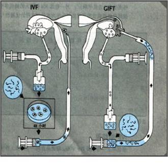 配子移植