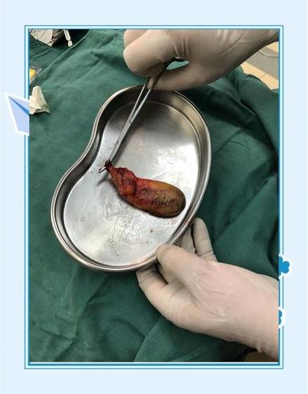 肝胆息肉手术