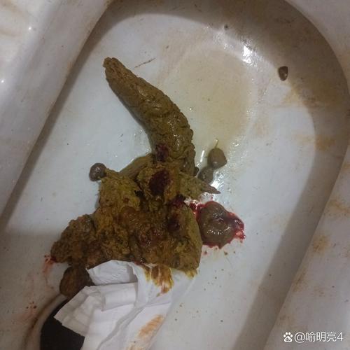 排便出血