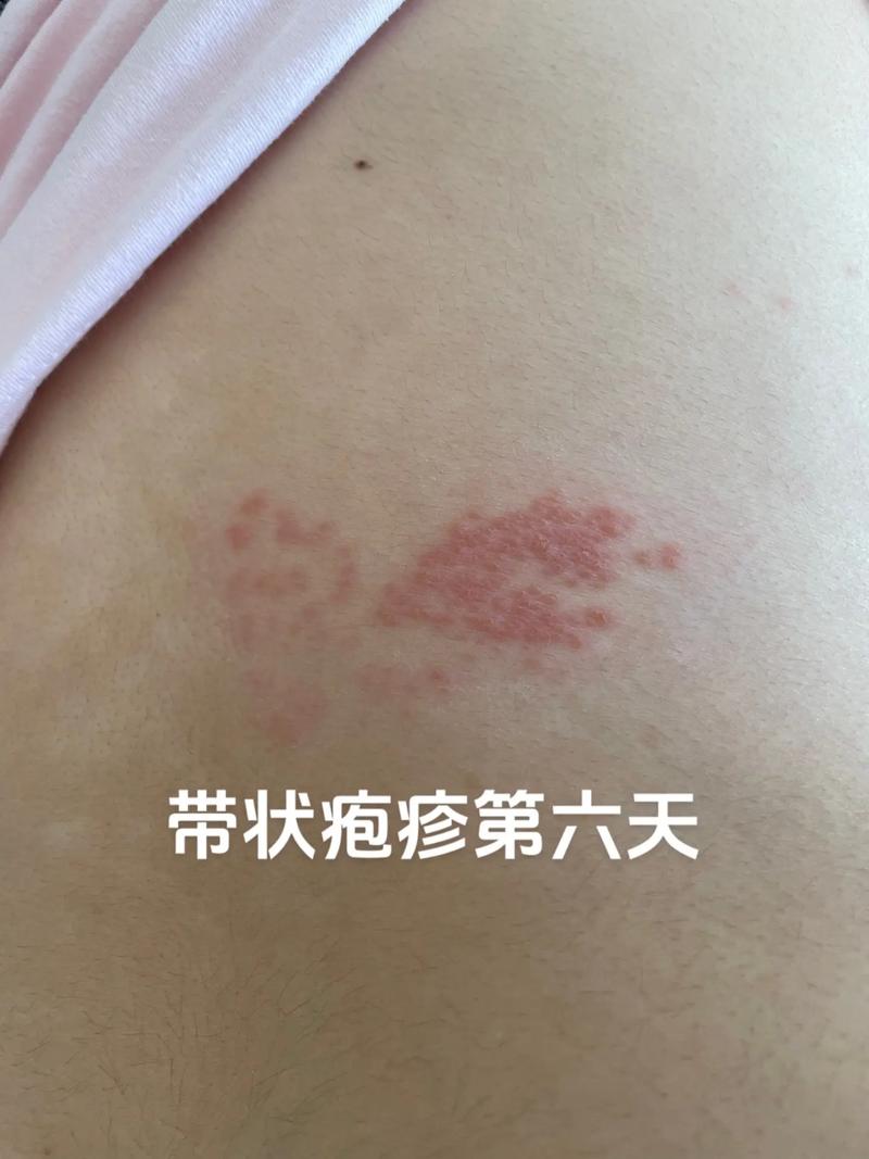 第六天症状