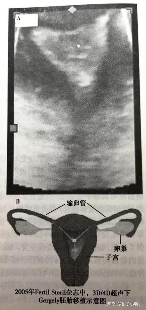 胚胎放置技巧