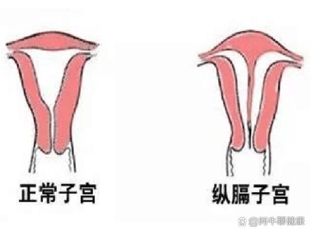 完全纵隔试管移植
