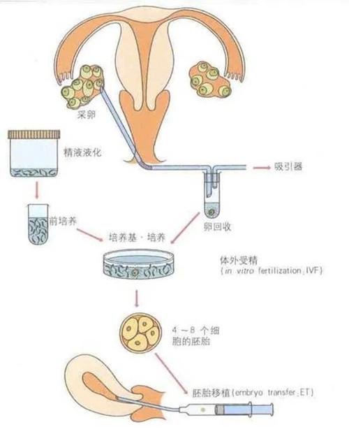 单管单卵试管技术