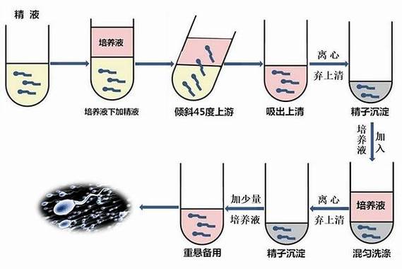 精子梯度洗涤