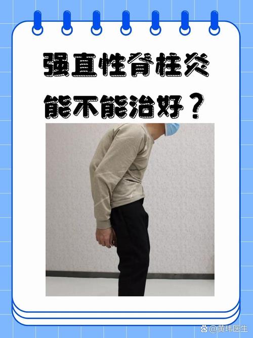  强直性脊柱炎