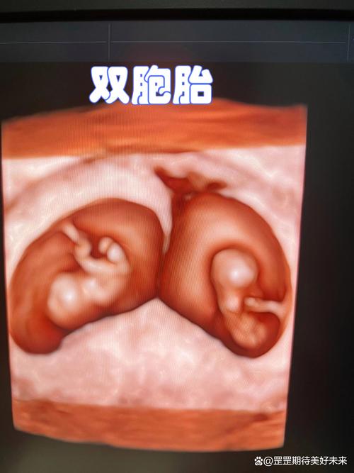 双胚胎