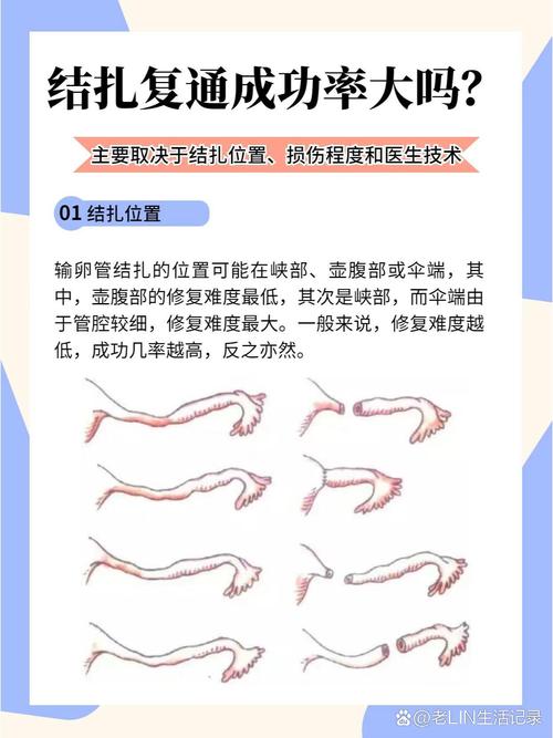 结扎成功率
