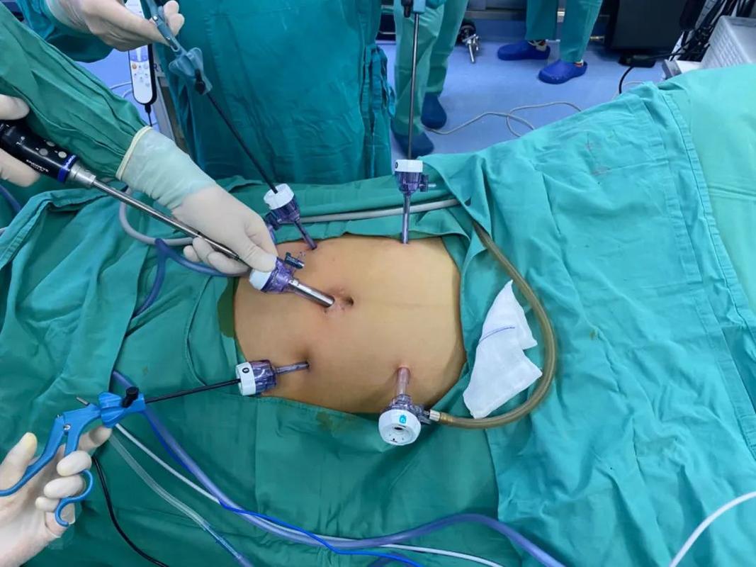 腹腔镜治疗