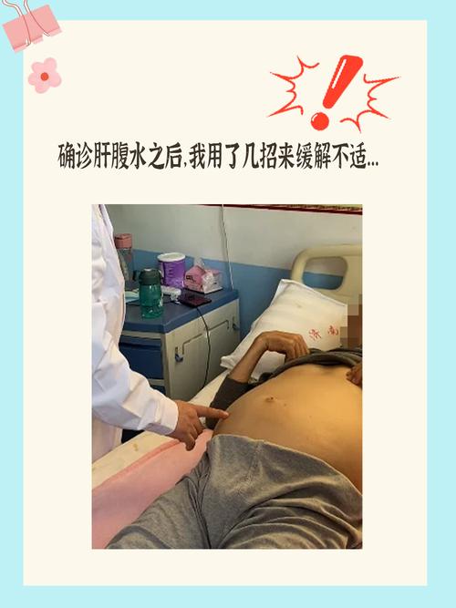 重度腹水