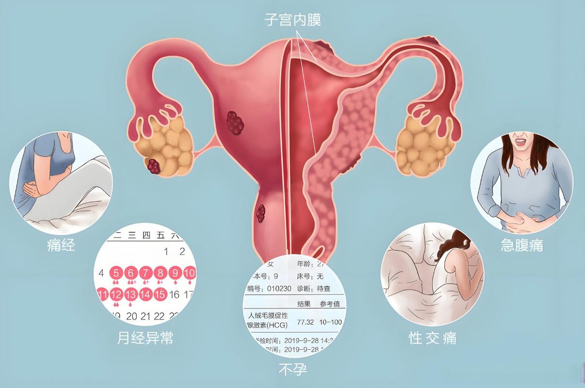 子宫排异