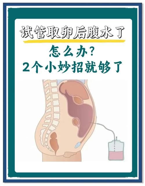 取卵后腹水