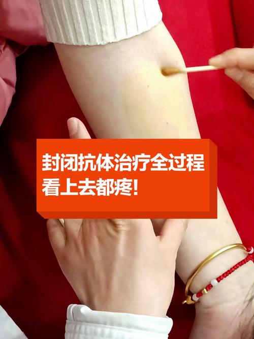  抗体封闭治疗