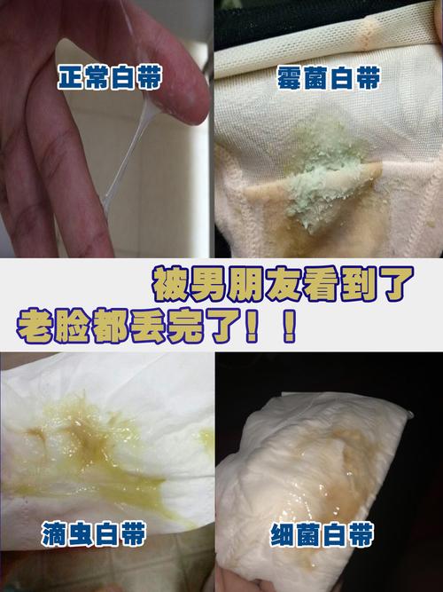  白带发黄