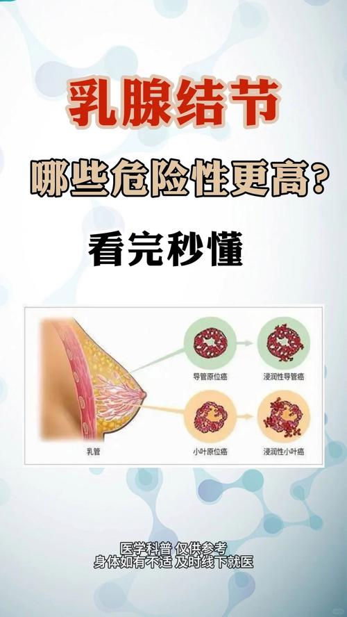 乳腺增生结节