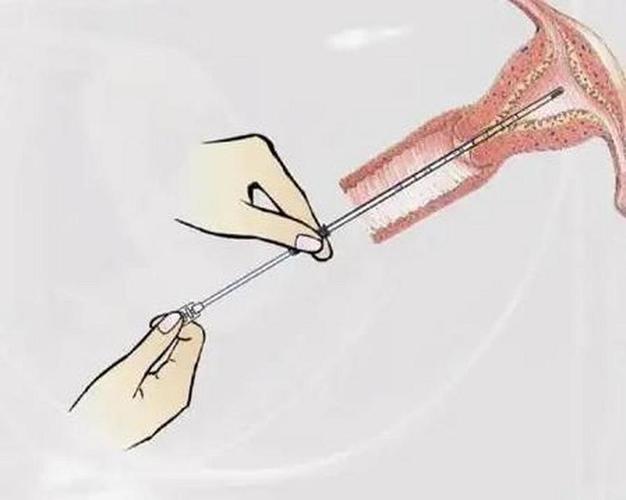  试管诊刮