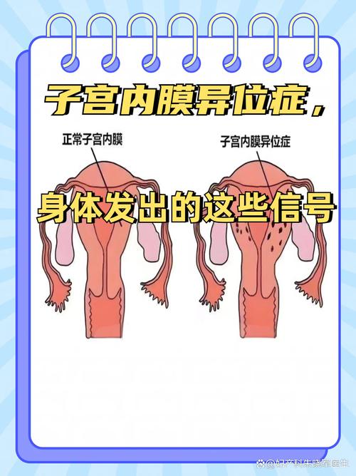 子宫内膜异位