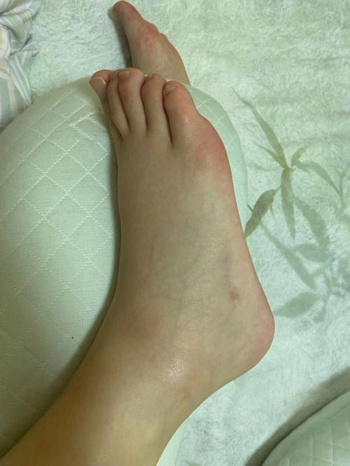  脚肿
