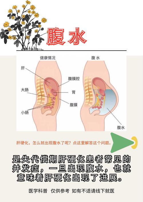  腹水风险