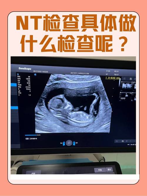 NT筛查