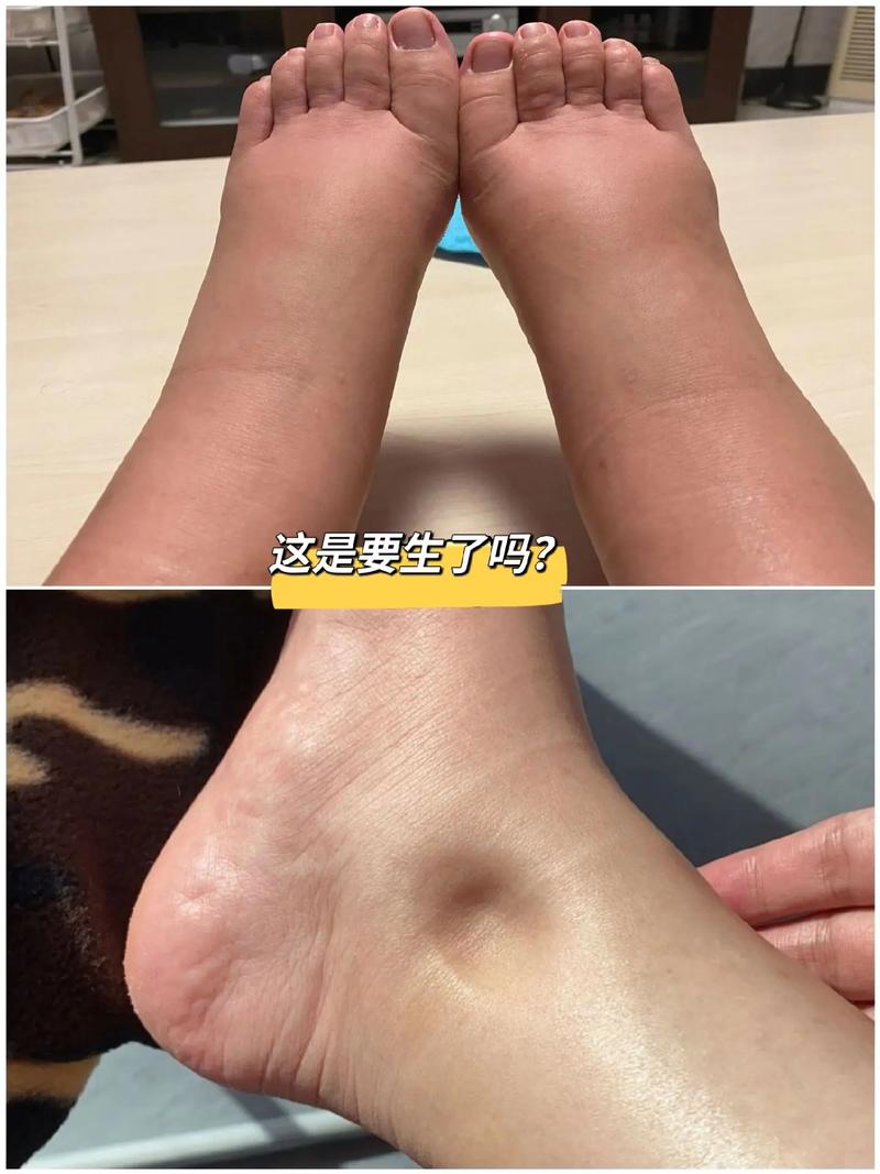  脚水肿
