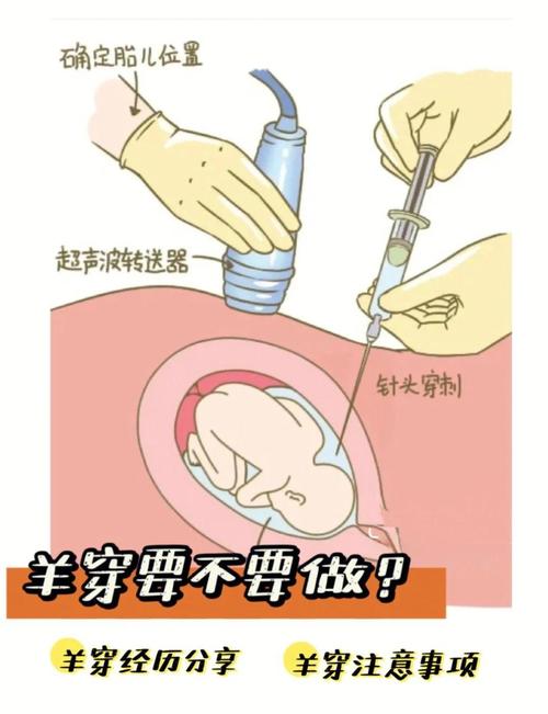 羊穿术